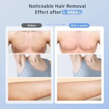 Ubroo IPL Laser Hair Removal Device with Ice Cooling