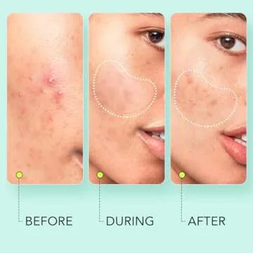 LitBear Large Pimple Patches - 306 Count for Acne Treatment