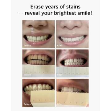 Live Orals Pure Dia Teeth Whitening Gel - Safe at-Home Kit, Hydrogen Peroxide, Mouthpiece. Dentist Formulated for Sensitive Teeth, 28 Treatments