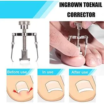 Ingrown Toenail Tool Kit by Dualeco - 9 Piece Set