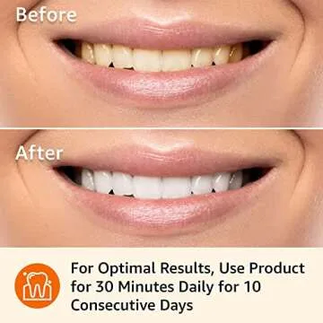 Amazon Basics 10 Day Teeth Whitening Strips Kit, 10 Treatments