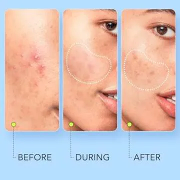 LitBear Pimple Patches - 7 Sizes for All Acne Types