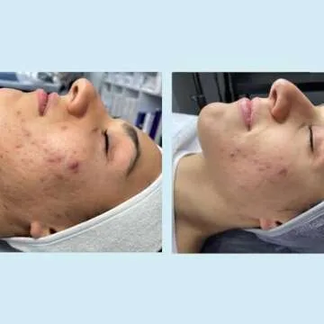 Salicylic Gel Chemical Peel with Green Tea and Tea Tree Oil