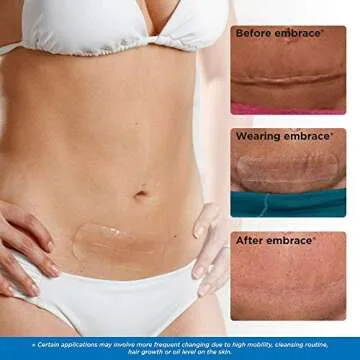 Embrace Active Scar Defense for New Scars Treatment