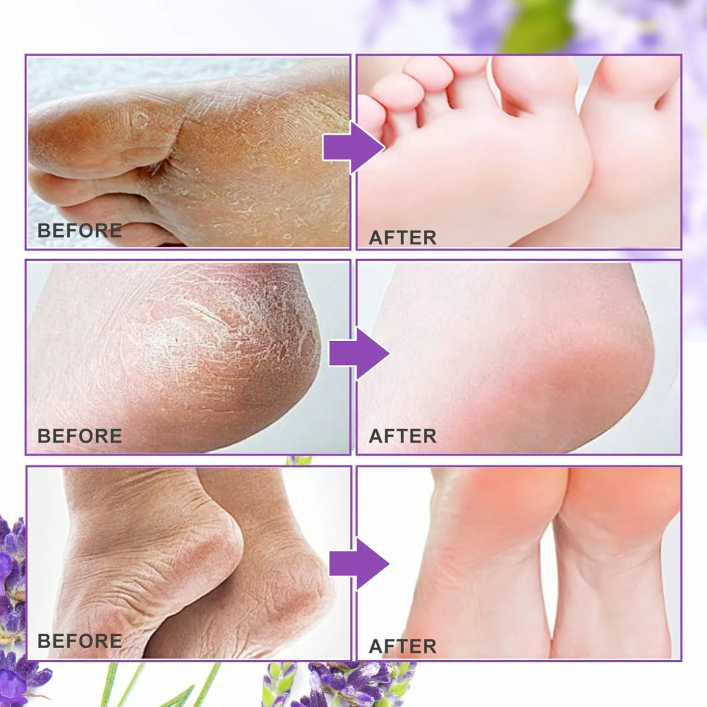 ALIVER Foot Peel Mask - Exfoliating Callus Remover