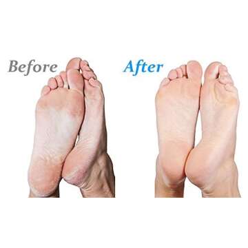 Emjoi Micro-Pedi 3D POWER Callus Remover with Xtreme Coarse Soft & Flexible Roller (Most Powerful & Corded)