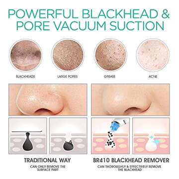 VOYOR Blackhead Remover Electric Pore Vacuum for Clear Skin