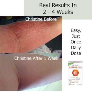 Loma Lux Eczema Pill – Natural Eczema Treatment – Dermatologist Developed – 7 All Natural Minerals Clear & Prevent Eczema Scaling, Rash, Itch, Inflamed Skin for Kids & Adults