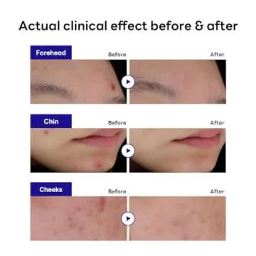 MEDIHEAL Derma Clear Madecassoside Blemish Spot Patch (44 Counts) - Acne Spot Protection, Spot Fast Healing with Madecassoside & Niacinamide