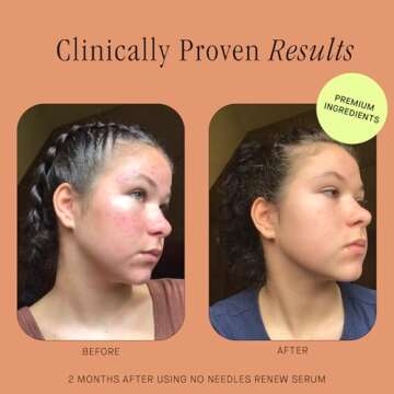 Brandefy No Needles Niacinamide Serum for Radiant Skin