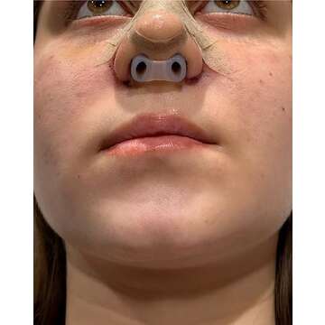 Nostril Retainer for Rhinoplasty Recovery Aid