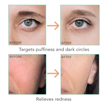 Ice Roller for Face - Soothing Relief for Puffiness