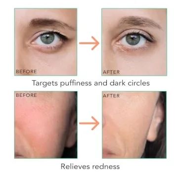 Ice Roller for Face - Soothing Relief for Puffiness