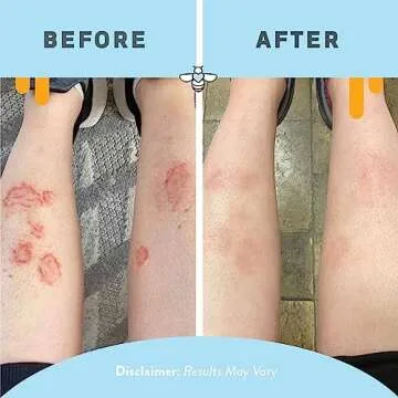 PSORIASIS HONEY Cream - Natural Eczema Treatment 4oz