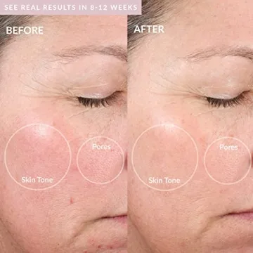 PMD Beauty Microderm Elite Pro At-Home Microdermabrasion Machine