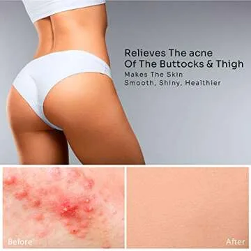 BellamiLuxx Butt Acne Clearing Treatment: with 2% Salicylic Acid and Tea Tree Oil, Effective Body Ac...
