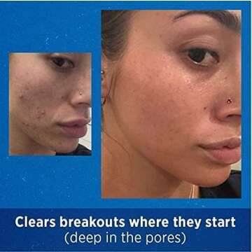 Differin Adapalene Gel 0.1% Acne Treatment for Clear Skin