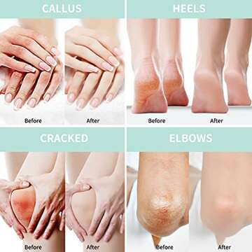 Grocerism Urea Cream 40 Percent For Feet Plus 2% Salicylic Acid 5.29 oz || Foot Cream and Hand Cream Maximum Strength with Hyaluronic Acid,Tea Tree,and Aloe Vera For Deep Moisturizes,Callus Remover