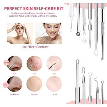 JPNK NEW Blackhead Remover Tools Comedone Extractor Acne Removal Kit for Blemish (Silver)