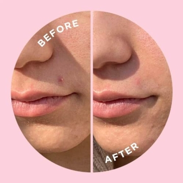 ZitSticka Goo Getter Pimple Patches Fast Acne Relief