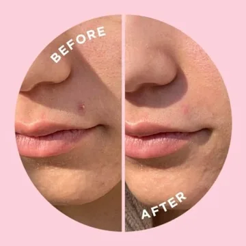 ZitSticka Goo Getter Pimple Patches Fast Acne Relief