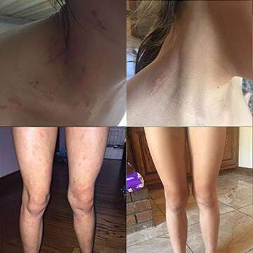 Lingon Emulsion - 1 for Eczema Relief 15ML