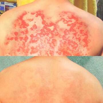 Lingon Emulsion - 1 for Eczema Relief 15ML