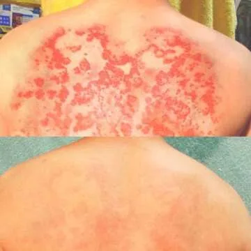 Lingon Emulsion - 1 for Eczema Relief 15ML