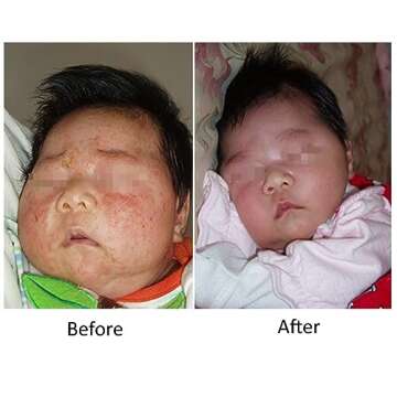 Lingon Emulsion - 1 for Eczema Relief 15ML