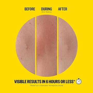 PEACE OUT Skincare Acne Day Dot. 6-hour Fast Acting Sheer Hydrocolloid Pimple Patches with Salicylic Acid, Ultra-Thin, Virtually Invisible, Quickly Clear Breakouts, Blemishes and Zits, 20 dots