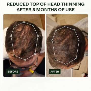 Bio-Pilixin Activation Serum 100ml with Clinically Tested Results in 150 days - Scandinavian Biolabs Hair Loss Serum for Men Sulphate Free - No Silicones No Parabens