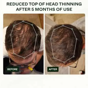 Bio-Pilixin Activation Serum 100ml with Clinically Tested Results in 150 days - Scandinavian Biolabs Hair Loss Serum for Men Sulphate Free - No Silicones No Parabens