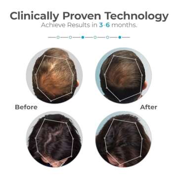 Capillus Plus Mobile Laser Therapy Cap for Hair Regrowth, with 202 Red Light Lasers for Laser Hair Growth, Red Light Hair Growth