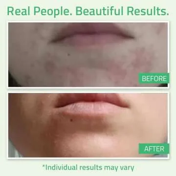 YEOUTH Glycolic Acid Peel for Face Exfoliator 30%