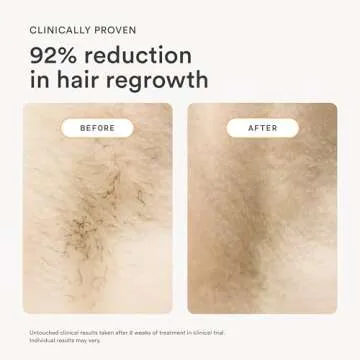 Nood Flasher 2.0 Kit — IPL Hair Removal Device for All