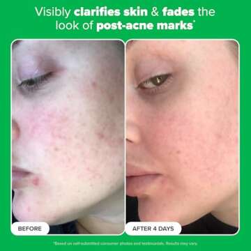 Paula’s Choice BOOST 10% Azelaic Acid Oil-Free Serum