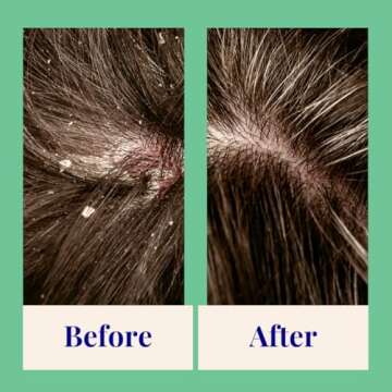 Exfoliating Foaming Powder Shampoo for Dandruff | 20x Washes | Vegan, Eco-Friendly, Tea Tree, Salicylic Acid 0.7 Oz Mini Aluminum Bottle