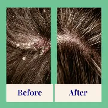 Exfoliating Foaming Powder Shampoo for Dandruff | 20x Washes | Vegan, Eco-Friendly, Tea Tree, Salicylic Acid 0.7 Oz Mini Aluminum Bottle