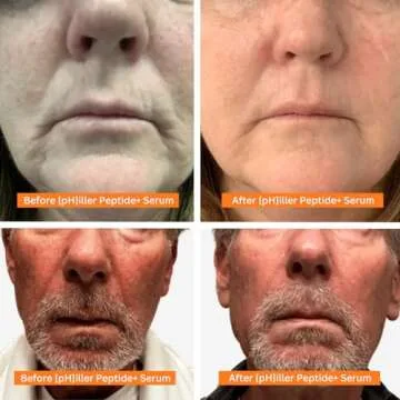 The PHIX pHiller Peptide Serum - Advanced Anti Aging Face Tightening Serum for Fine Lines and Wrinkles, Hydrating Peptides Facial Formula for Skin, with Argireline + Tripeptides; Vegan (1oz)