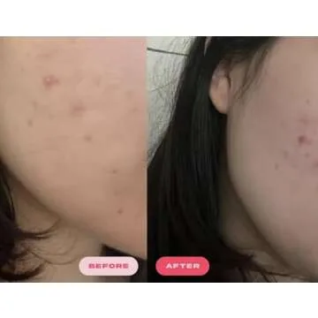 Plumpie Hydro Patch Bigger & Thicker Pack- Hydrocolloid Acne Pimple Patch for Healing and Covering Zits and Blemishes, For Face and Skin, Vegan and Cruelty-Free (36 Count) (Designer 36 Count)