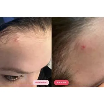 Plumpie Hydro Patch Bigger & Thicker Pack- Hydrocolloid Acne Pimple Patch for Healing and Covering Zits and Blemishes, For Face and Skin, Vegan and Cruelty-Free (36 Count) (Designer 36 Count)