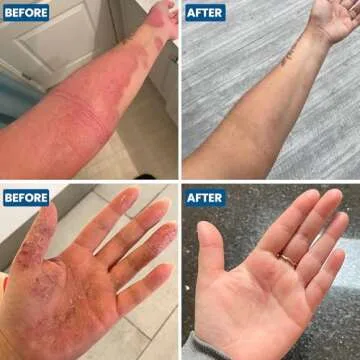 Grahams Natural C+ Eczema Relief Cream - Nourishes & Soothes Dermatitis, Inflammation, Redness Treatment for Irritated, Dry Skin - All Natural Ingredients with Manuka honey, Steroid-Free (1 x 1.76oz)