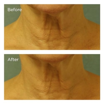 Transformative Neck & Chest Cream with SPF 25 for Youthful Skin