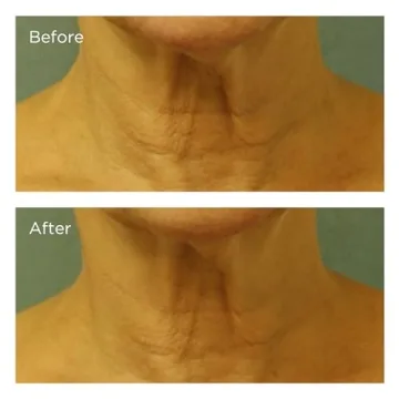 Transformative Neck & Chest Cream with SPF 25 for Youthful Skin