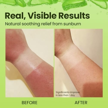 Honeyskin Soothing Aloe Vera Gel for Summer Relief