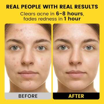 Effective Elvira Sulfur Drying Lotion for Acne Relief