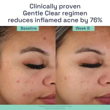 Cetaphil Gentle Acne Face Wash for Sensitive Skin