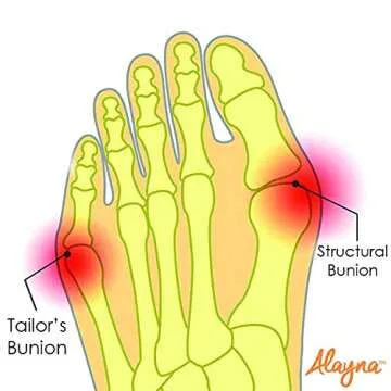 Bunion Corrector for Women and Men Big Toe Bunion Pain Relief Hallux Valgus Corrector Bunion Socks Splint Pads Protector Cushion Guards Bunion Support Brace Orthopedic Bunion Corrector Sleeve Spacer Separator Hammer Toe Corrector (Small)