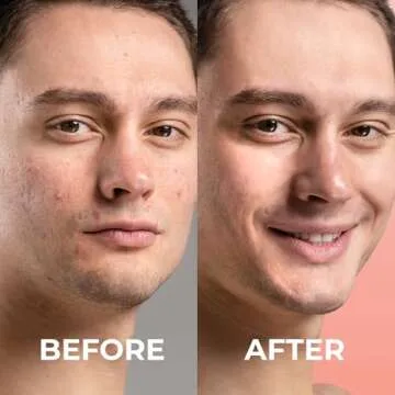 PatchRX Micro Needle Pimple Patch (18 Pack) - Hydrocolloid Micropoint Pimple Patch For Acne & Cystic Pimples, Eliminate Pimples Overnight, Microdart Pimple Patch, Micro Dart Pimple Patches