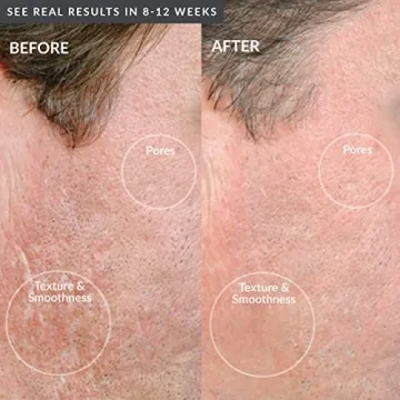 PMD Microdermabrasion Machine for Radiant Skin